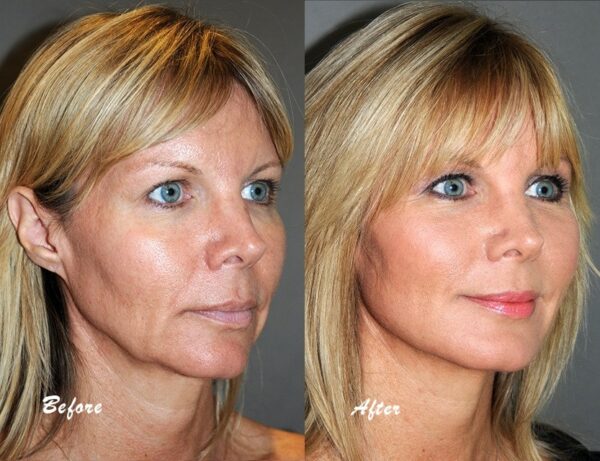 Phytoceramides with Skin Restoring Ceramides