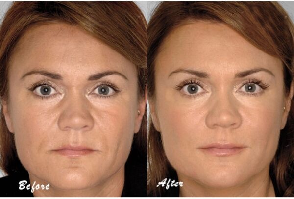 Phytoceramides Before and After 2