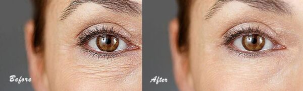 Phytoceramides Before and After
