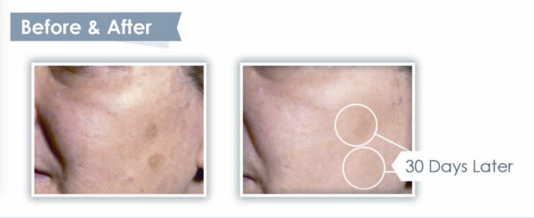 Vitaderm C Plus Before and After